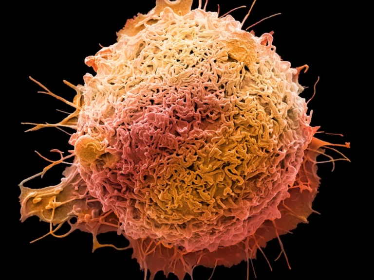 Médicos alertam para o ‘assustador’ crescimento do câncer colorretal em pessoas de até 50 anos